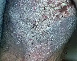 Lupus vulgaris, changes in skin in hyperkeratotic forms