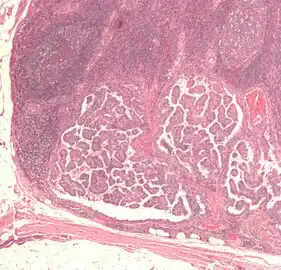 Micrograph of thyroid cancer (papillary thyroid carcinoma) in a lymph node of the neck. H&E stain