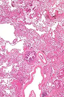 Micrograph of lymphangioleiomyomatosis.