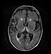 Axial MRI FLAIR image showing hyperintense signal in the mesial dorsal thalami, a common finding in Wernicke encephalopathy.  This patient was nearly in coma when IV thiamine was started, he responded moderately well but was left with some Korsakoff type deficits.