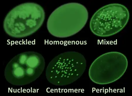 Main antinuclear antibody patterns on immunofluorescence. CREST syndrome typically displays the centrome pattern.