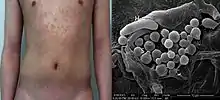 Appearance: Pityriasis versicolor in a man. Electron micrograph: round Malassezia spores (S) and filaments