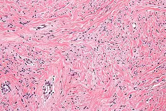 High mag. Mammary myofibroblastoma