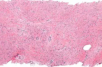 Intermed. mag. Mammary myofibroblastoma