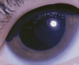 A lens dislocation caused by Weill-Marchesani syndrome