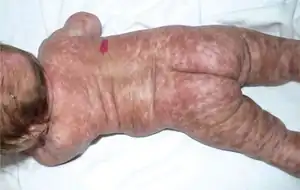 Diffuse cutaneous mastocytosis