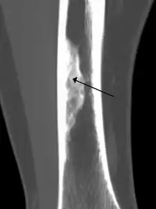 2. An ossified non-ossifying fibroma on CT