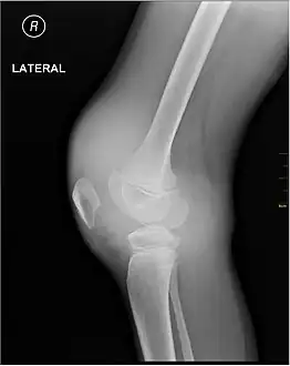 X-ray of Hemarthrosis