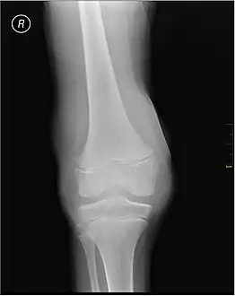 X-Ray- haemoarthritis