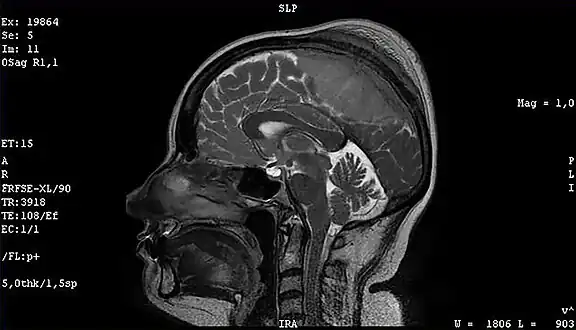 Meningioma of the middle third of the sagittal sinus with large hyperostosis