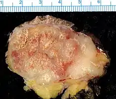 Merkel-cell carcinoma. Gross pathology specimen