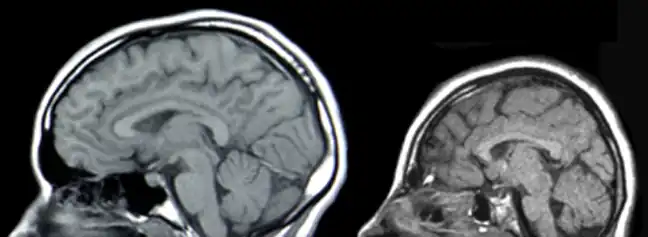 Neural scans of a normal-sized skull (left) and a case of microcephaly