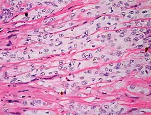 Poorly differentiated, where attempts at keratinization are often no longer evident. This is a clear-cell squamous cell carcinoma. The dysplastic cells here infiltrate in cords through the dermis. Poorly differentiated SCC has greatly enlarged, pleomorphic nuclei demonstrating a high degree of atypia and frequent mitoses.