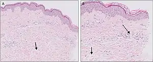 Micrograph of urticaria. Dermal edema [solid arrows in (A,B)] and a sparse superficial predominantly perivascular and interstitial infiltrate of lymphocytes and eosinophils without signs of vasculitis (dashed arrow).