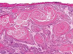 Well-differentiated (and yet invasive) SCC, showing prominent keratinization and may form “pearllike” structures where dermal nests of keratinocytes attempt to mature in a layered fashion. Well-differentiated SCC has slightly enlarged, hyperchromatic nuclei with abundant amounts of cytoplasm. Intercellular bridges will frequently be visible.