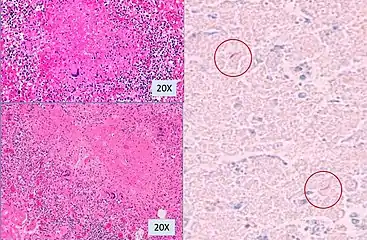 Histopathology, showing epithelioid granulomas with multinucleated giant cells and acid-fast bacilli