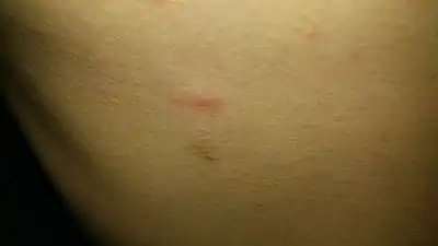 Mite bite on chest