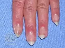 Mixed connective tissue disease