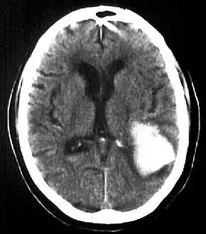 Intraparenchymal hemorrhage