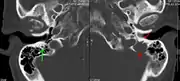 A CT of the brain revealed a lytic lesion in the left temporal bone (right side of image), and petrous temporal bones involving the mastoid segment of the facial nerve canal. Red arrows: lesion; green arrow: normal contralateral facial nerve canal. The lesions are consistent with a myeloma deposit.