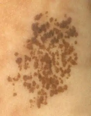 Nevus spilus