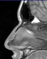 Nasal bone fracture