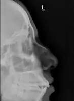 Nasal bone fracture