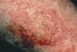 Necrolytic migratory erythema