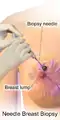 Needle breast biopsy.