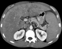 Non-Hodgkin lymphoma with hepatic involvement