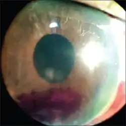 Small hyphema (grade I)