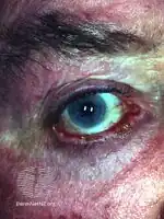 Ocular pemphigus vulgaris