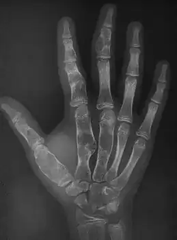 X-ray hand:Ollier disease in child