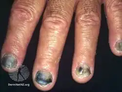 Melanonychia (whole nail)