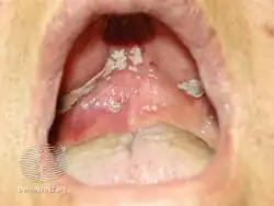 Oral candidiasis