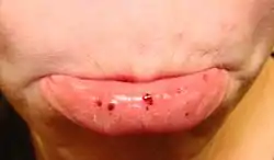 Petechiae/purpura - lower lip