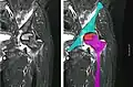 Nuclear magnetic resonance of avascular necrosis of left femoral head. Man of 45 years with AIDS.