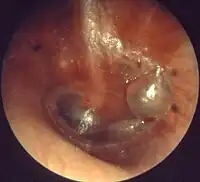 Acute otitis media, myringitis bullosa