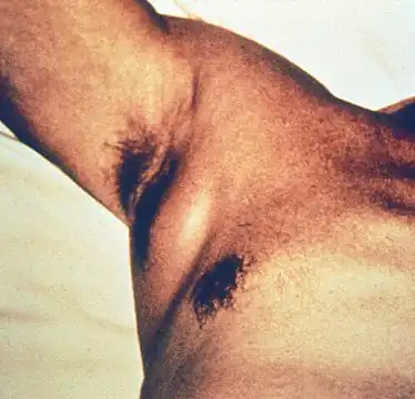 Swollen axillary lymph node