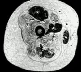 Transverse section from child  with central core disease