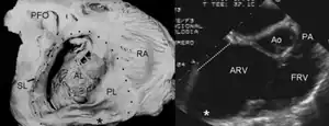 Ebstein's anomaly shows  dilatation at atrioventricular junction and aneurysmal fibrous sac asterisk (and echocardiogram asterisk)