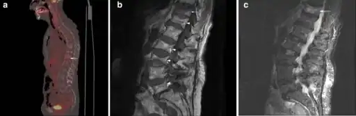 a) Sagittal fused FDG-PET/CT image demonstrates multiple compression fractures throughout the thoracic and lumbar spine b) sagittal  MRI demonstrates multiple chronic compression fractures  c) sagittal STIR image demonstrates mild edema in  T11 compression fracture