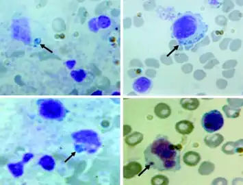 Peripheral blood smears  shows variable-sized basophilic inclusions in mononuclear cells from child with human monocytic ehrlichiosis