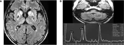 a)High signal  caudate and lenticular nuclei b) long echo time in deep left cerebellum