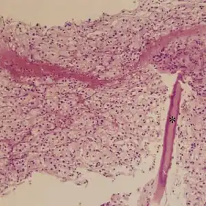 Metastatic alveolar soft part sarcoma of lumbar vertebrae