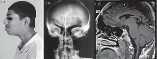 a) Prominent superciliary arches, prognathism b) prominent frontal/maxillary sinuses c) large sphenoid