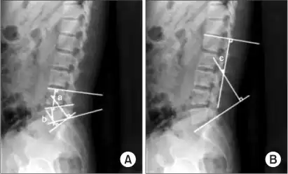 a,b)Cobb's angle for segmental lordosis and whole lumbar lordosis