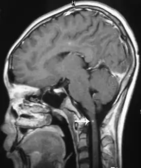 Angiostrongylus cantonensis lesions in brain