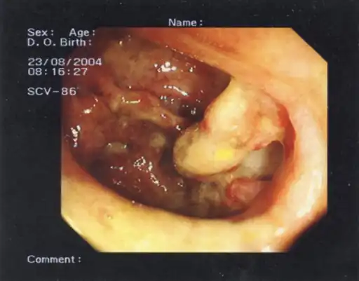 Toxic megacolon (and an appendiceal-sigmoid fistula).