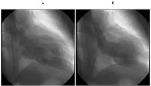 a)Diastolic phase b) systolic phase shows apical ballooning with sparing of  apex  indicative of takotsubo cardiomyopathy